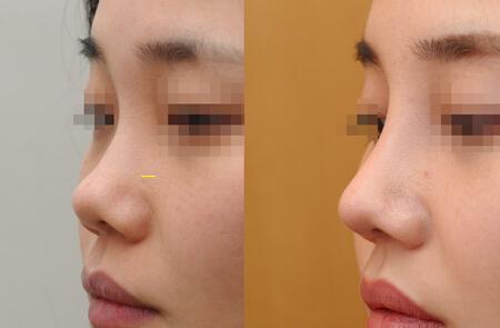 如何分辨隆鼻与鼻综合手术？