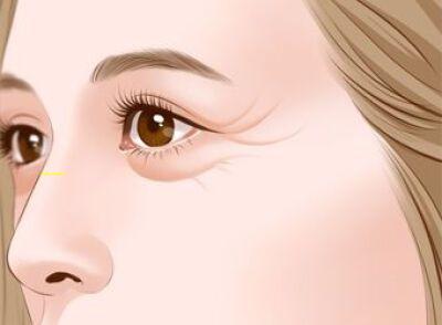 阿尔法双眼皮(美杜莎双眼皮和普通双眼皮的区别)